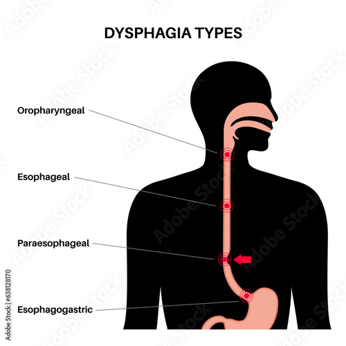 Dysphagia medical poster