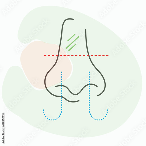 Nasal obstruction is when the nasal passages are blocked, or there is difficulty breathing from the nose