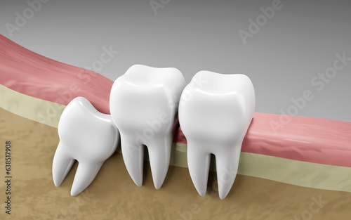 Wisdom tooth impaction. Oral health and dental inspection teeth. Medical dentist tool  children healthcare  3D render