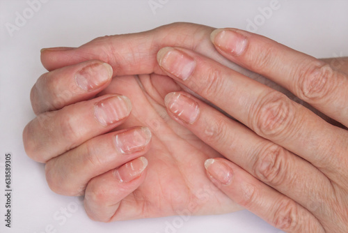 close-up photo of female age-related hands with white stripes on the nails from lack of vitamins