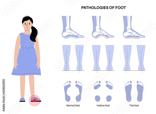 Foot pathologies poster photo