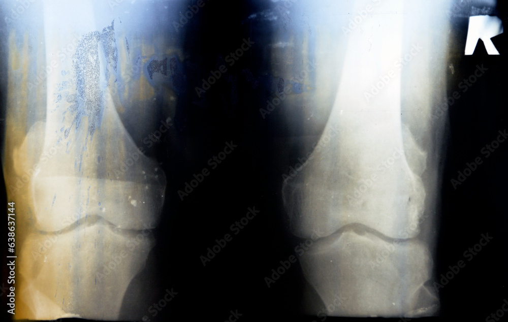 Old retro Plain X ray of the right knee shows apparent joint ...