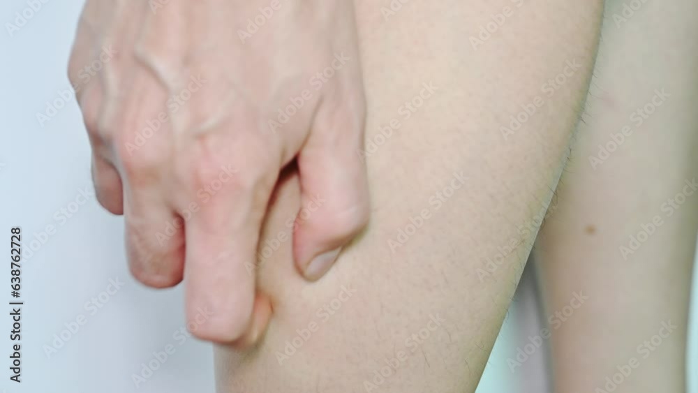 Someone scratching wound on leg caused of Mosquito bites. Mosquito bites are the itchy bumps that form on the skin after mosquitoes feed on your blood. Someone scratching wound on leg caused of Mosquito bites. Mosquito bites are the itchy bumps that form on the skin after mosquitoes feed on your blood.
