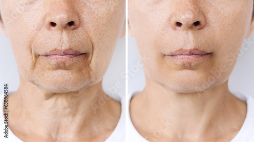 Bild auf Leinwand Lower part of face and neck of a caucasian elderly woman with signs of skin aging before after facelift, plastic surgery