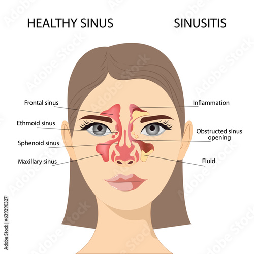 Sinusitis, Female face with inflammation of the mucous membrane of the paranasal and frontal sinuses. Vector illustration for medical posters and educational materials