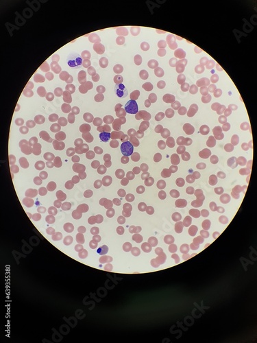 Microscopy of red blood cells & white blood cells in patient with acute promyelocytic leukaemia photo