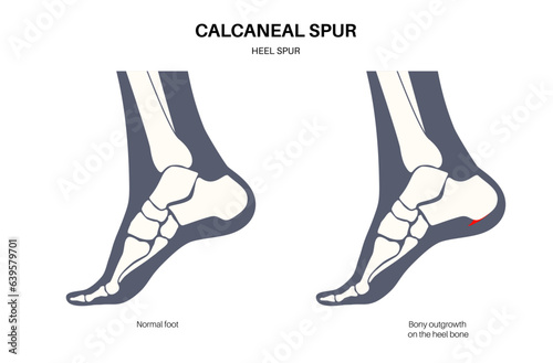Heel spur poster
