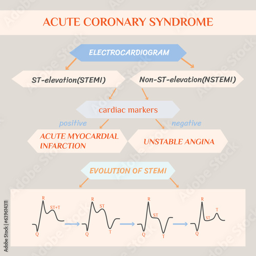 Acute coronary syndrome. Schematic Electrocardiogram of myocardial infarction (heart attack).