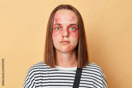 Serious confident woman in striped shirt with bruised skin standing isolated over beige background looking at camera has serious traumas after accodent feeling pain