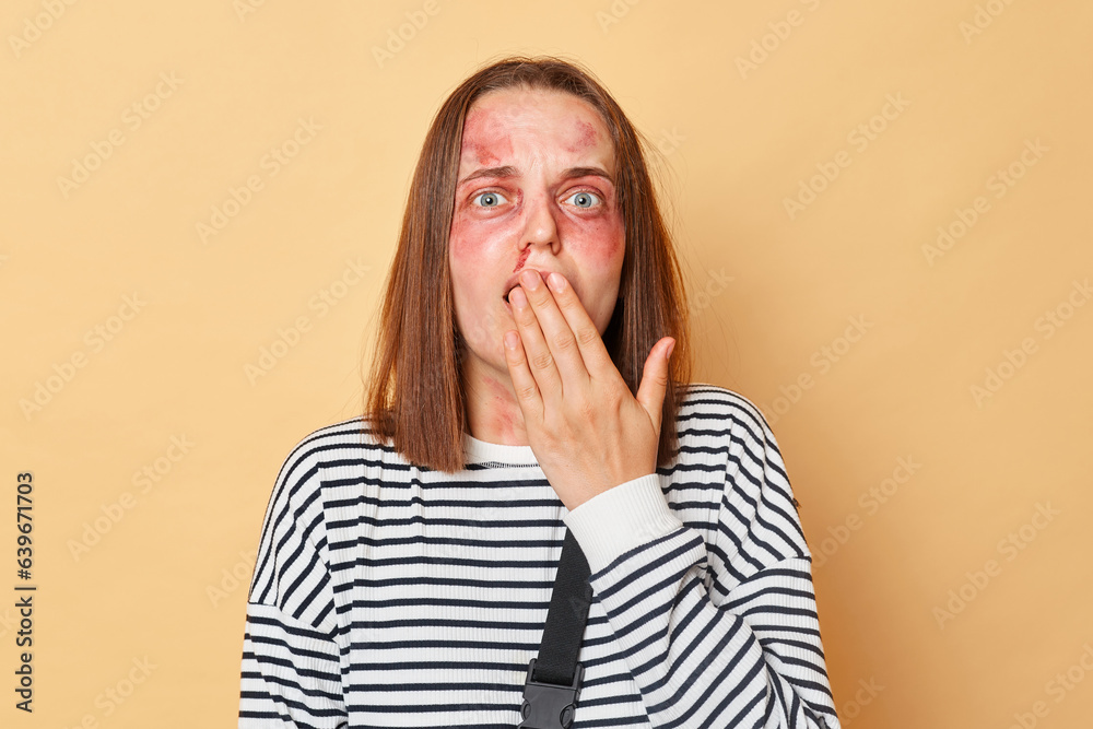 Shocked astonished suprised woman in striped shirt with bruised skin standing isolated over beige background looking at camera with big eyes covering eyes with palm. Shocked astonished suprised woman in striped shirt with bruised skin standing isolated over beige background looking at camera with big eyes covering eyes with palm.