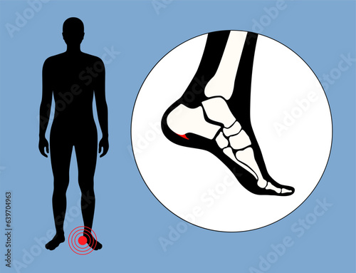 Heel spur poster
