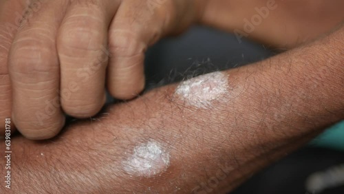 Psoriasis on hand, itching and scratching marks photo