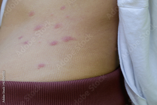 Red, swollen and itchy spots on skin caused by insect bites or allergy. Skin reaction to insect bites.