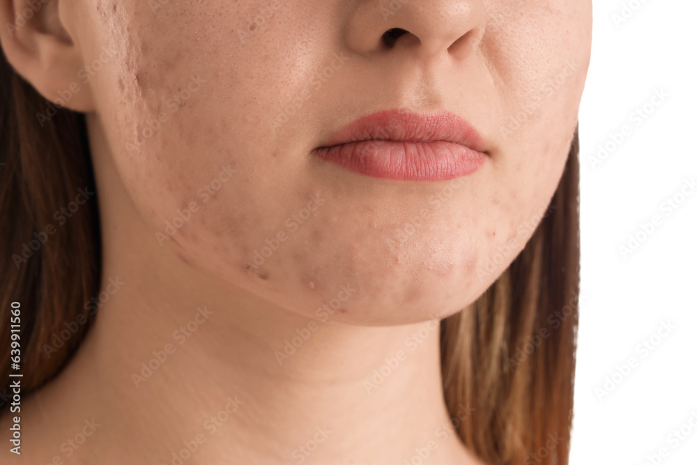 Obraz premium Teenage girl with acne problem on white background, closeup