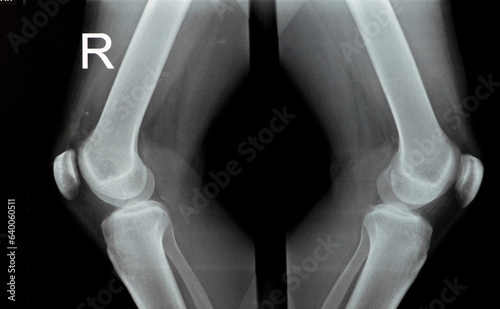 Plain X ray of both right and left knee joints with lower part of femur and upper parts of tibia and fibula and patella showing normal knee join of a young male that complains painful joint for MRI photo