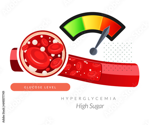 Hyperglycemia - High Blood Sugar Level - Stock Illustration