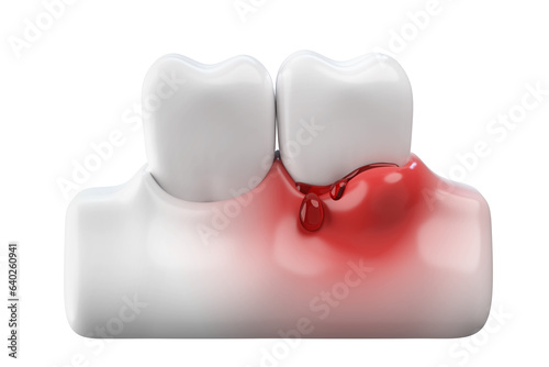 Bleeding gums and white teeth, gums disease or gingivitis concept. 3D rendering. photo