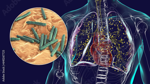 Bild auf Leinwand Human lungs affected by miliary tuberculosis, with a close-up view of the Mycoba