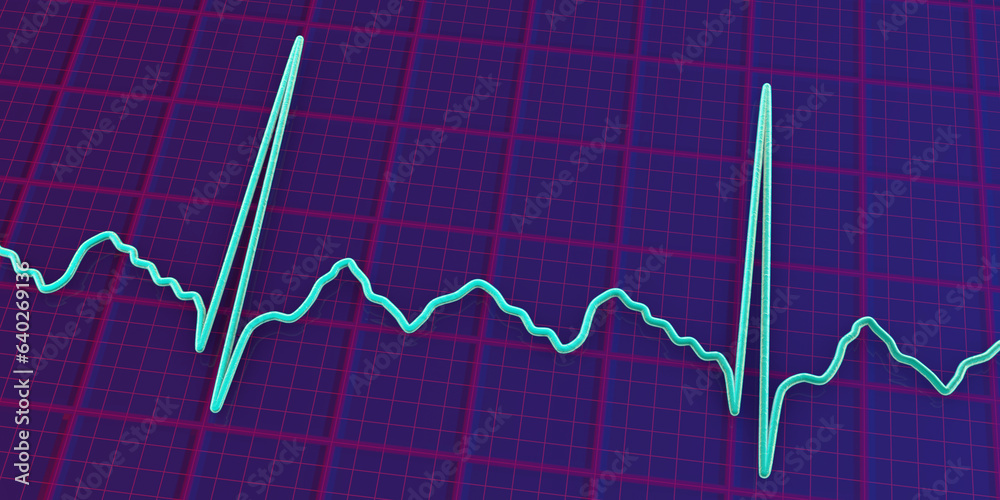 ECG in atrial flutter, 3D illustration ECG in atrial flutter, 3D illustration