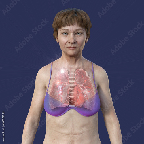 A female patient with lungs affected by apical tuberculosis, 3D illustration