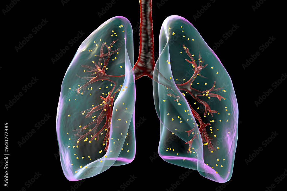 Lung adiaspiromycosis, 3D illustration Lung adiaspiromycosis, 3D illustration