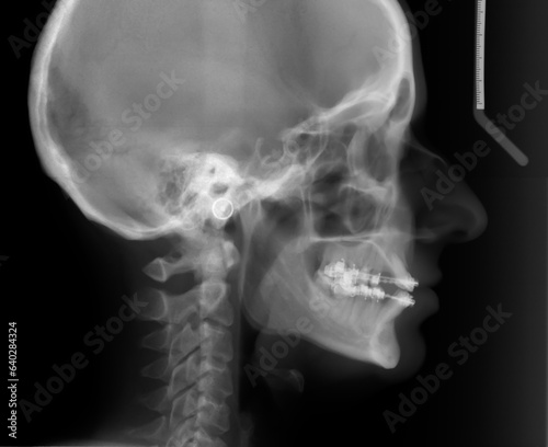 X Ray head with braces. Lateral Radiograph, used for orthodontic treatment photo