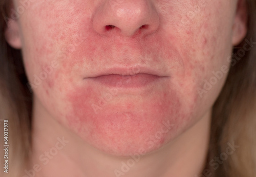 Seborrheic Dermatitis In the face of a young girl. Acne vulgaris and scars over whole face of Italian woman. close-up with focus on the problem. photo