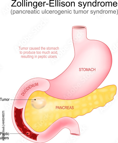 Zollinger-Ellison syndrome. Gastrinoma photo