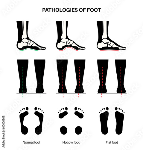 Foot pathologies poster
