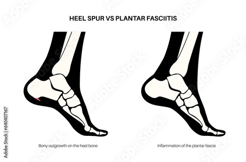 Heel spur and plantar fasciitis