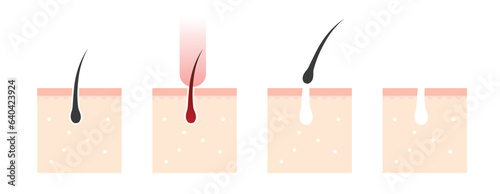 Laser hair removal steps. Process of laser epilation infographic. Human skin and hair follicles. Vector illustration.