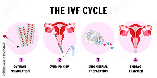 In vitro fertilization process IVF infographics and illustrations with steps 