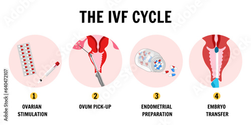 In vitro fertilization process IVF infographics and illustrations with steps  photo