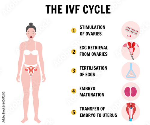 In vitro fertilization process IVF infographics and illustrations with steps 