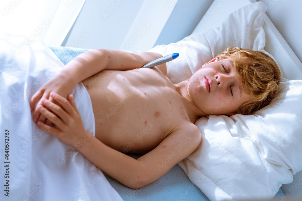 Boy with chickenpox measuring temperature