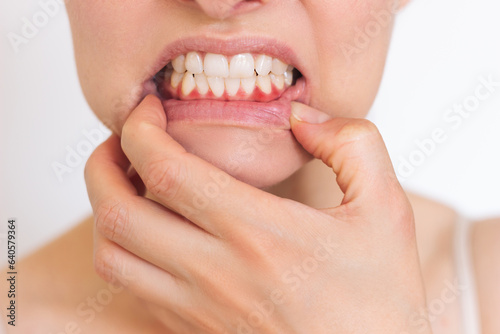 a close-up photo of a young woman who shows inflamed red bleeding gums isolated on a white background. Dentistry. Gum disease