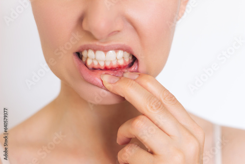 Fototapeta a close-up photo of a Caucasian young woman who suffers from inflammation of the gums on the lower jaw