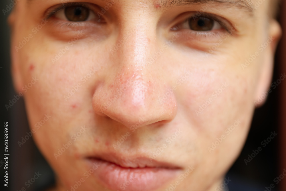 Skin condition of young man's face, close up Skin condition of young man's face, close up