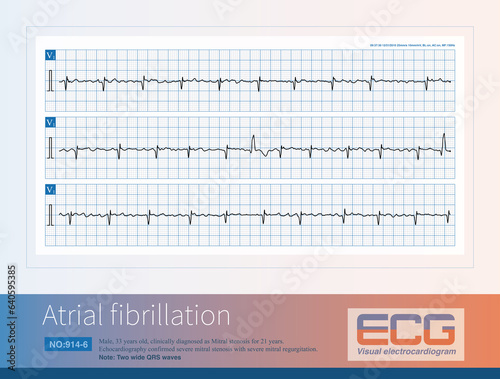 Male, 33 years old, clinically diagnosed with mitral stenosis. The rhythm displayed on the electrocardiogram is atrial fibrillation. Three electrocardiograms are continuous records.