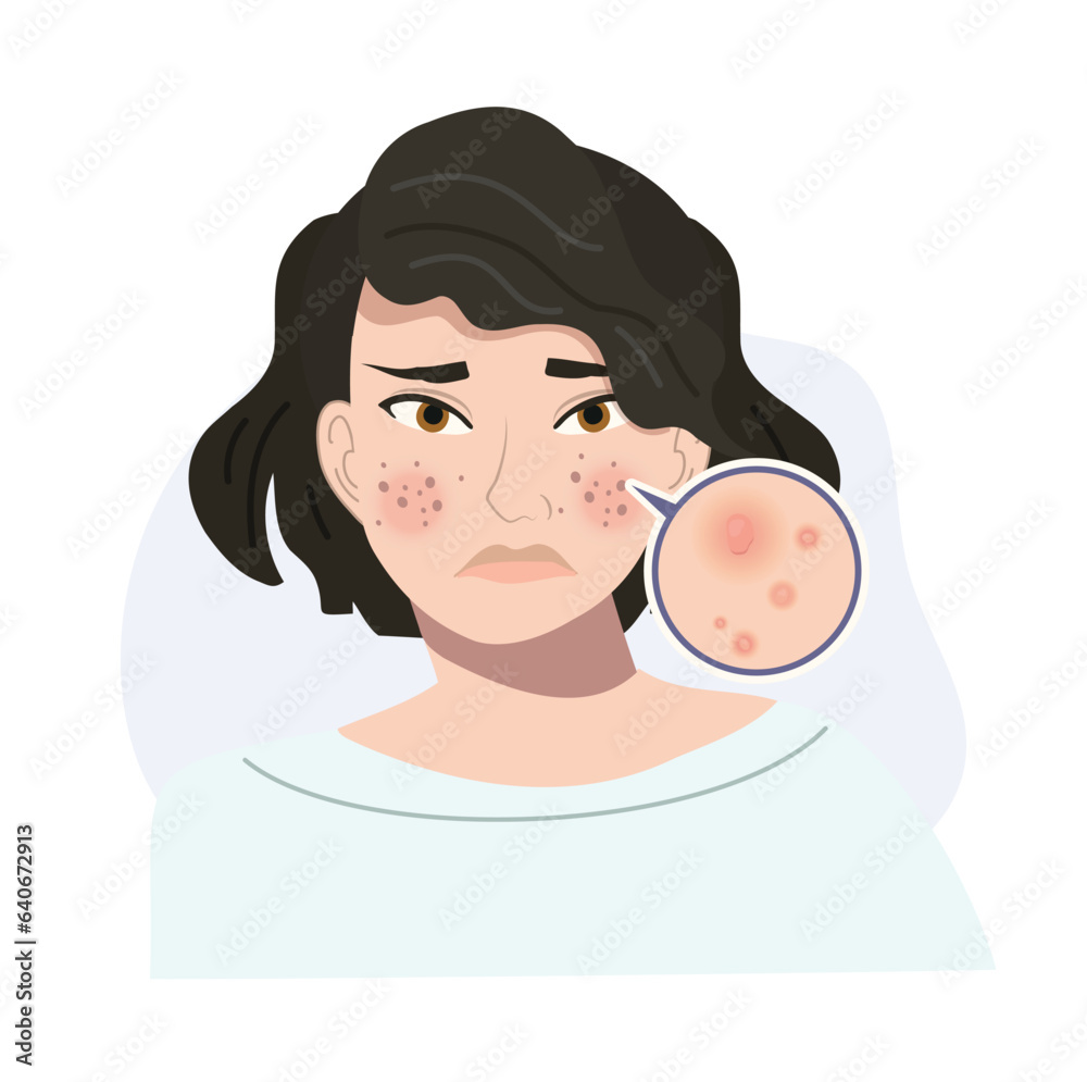 Portrait of Stressed Female with Troubled Skin. Acne, Nodule Skin Close Up. Flat vector cartoon illustration Portrait of Stressed Female with Troubled Skin. Acne, Nodule Skin Close Up. Flat vector cartoon illustration