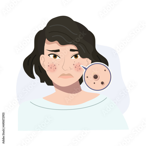 Portrait of Stressed Female with Troubled Skin. Acne, Blackhead Skin Close Up. Flat vector cartoon illustration