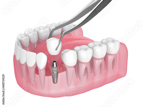 3d render of jaw with dental implant placement