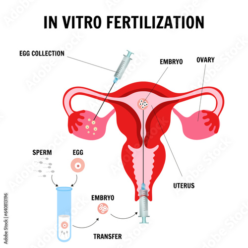 In vitro fertilization process IVF infographics and illustrations with steps 