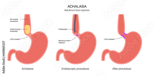 esophageal botulinum toxin injection