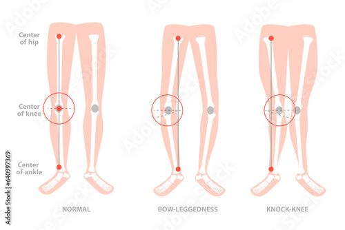 3D Isometric Flat  Conceptual Illustration of Valgus Deformity , Cosmetic Pathology