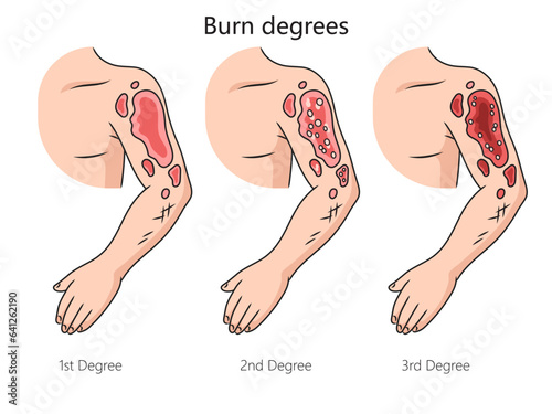 Burn degree diagram schematic vector illustration. Medical science educational illustration