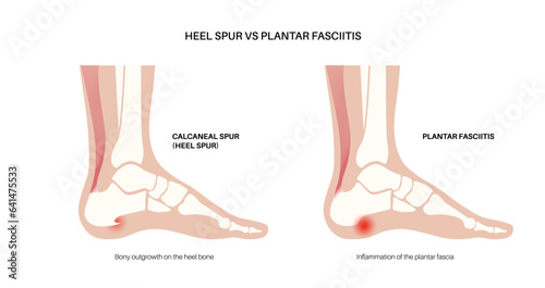 Heel spur and plantar fasciitis