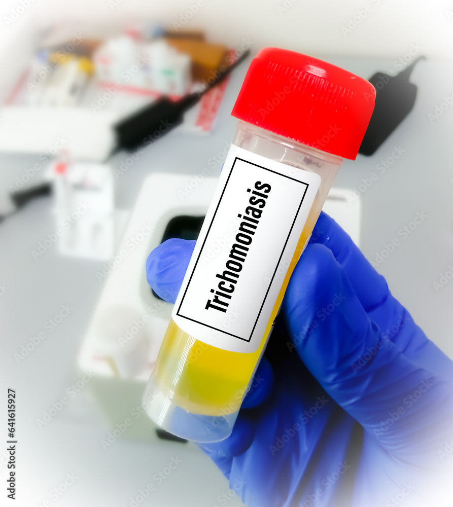 Urine sample for Trichomoniasis, is a very common STD caused by infection with Trichomonas vaginalis.