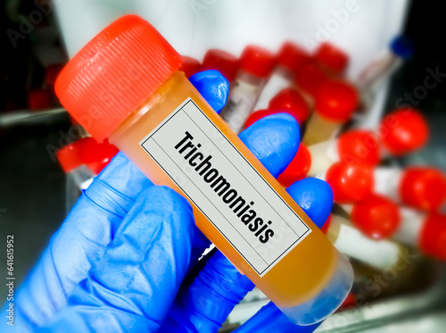 Urine sample for Trichomoniasis, is a very common STD caused by infection with Trichomonas vaginalis. photo