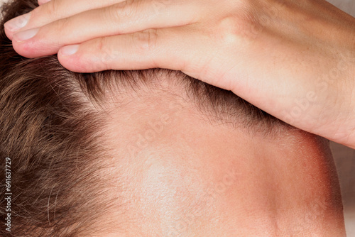 Close up of a young man holding his hair back showing clear signs of a receding hairline and hair loss photo